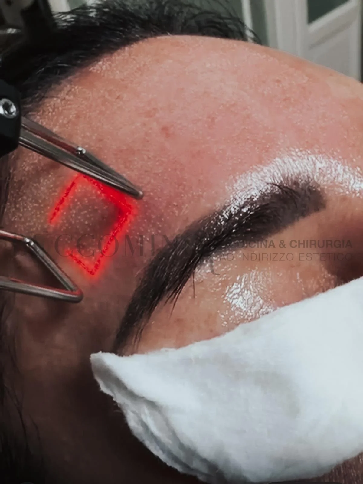 Laser frazionato: cos’è, come funziona e quando sceglierlo