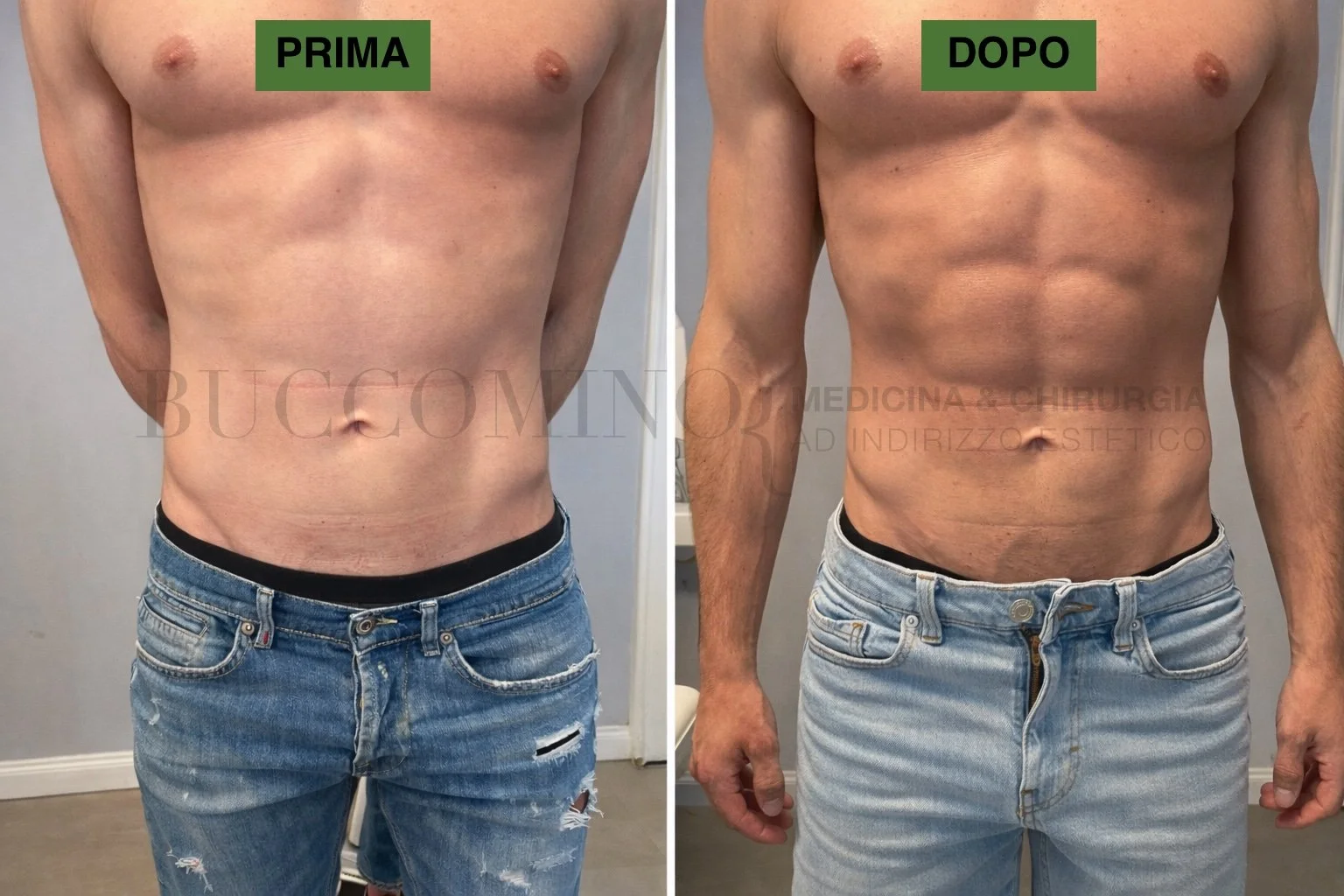 Scioglimento del Grasso con Sodiodesossicolato: Trattamento Efficace per Eliminare le Adiposità Localizzate