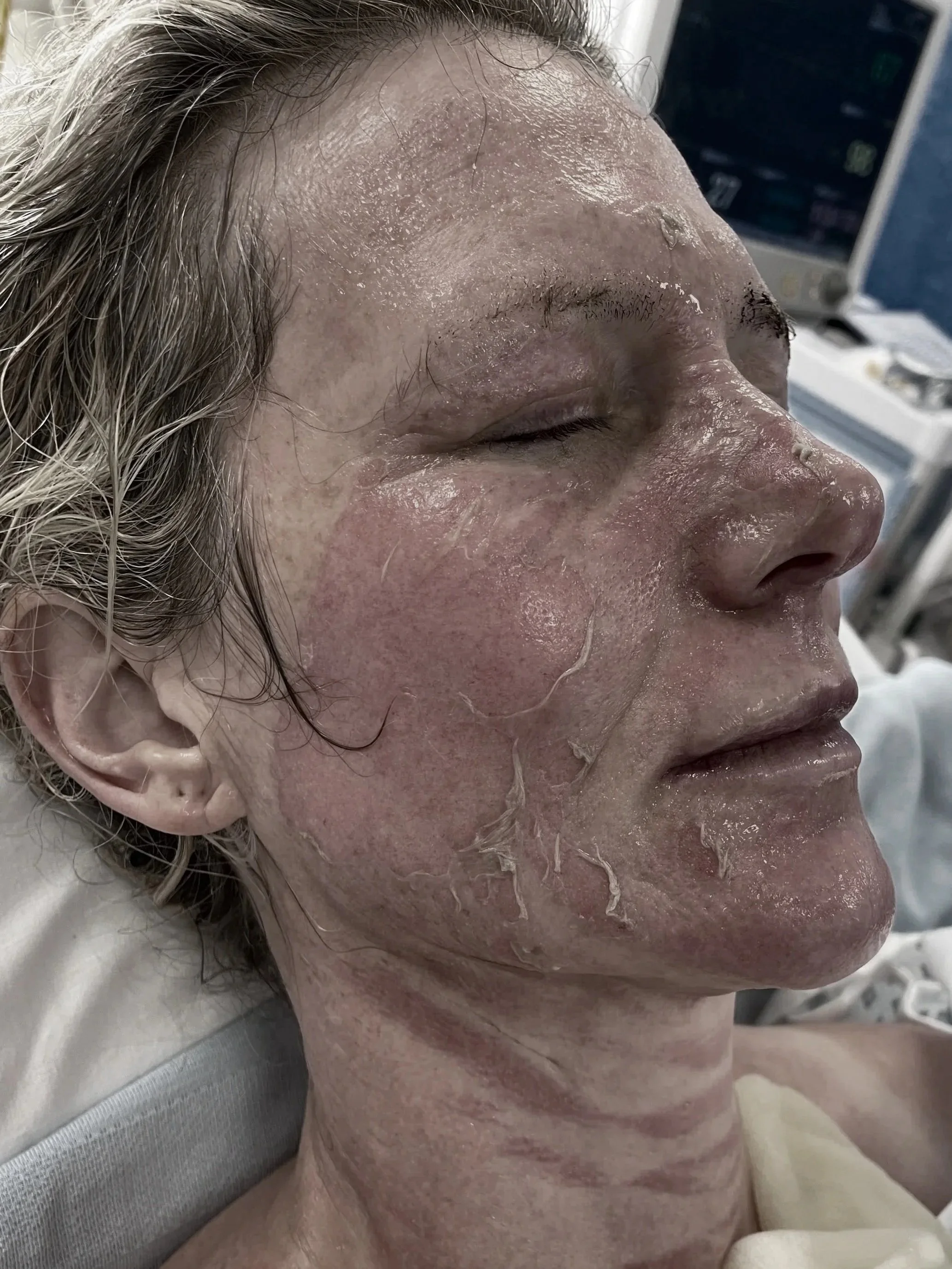 Burns Accident pic of me