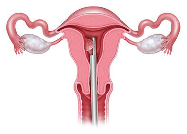 MyoSure passing through womb during hysteroscopy