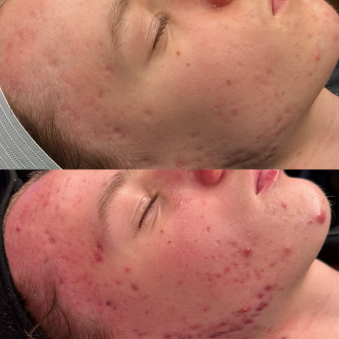Before and after of extreme acne on a young man