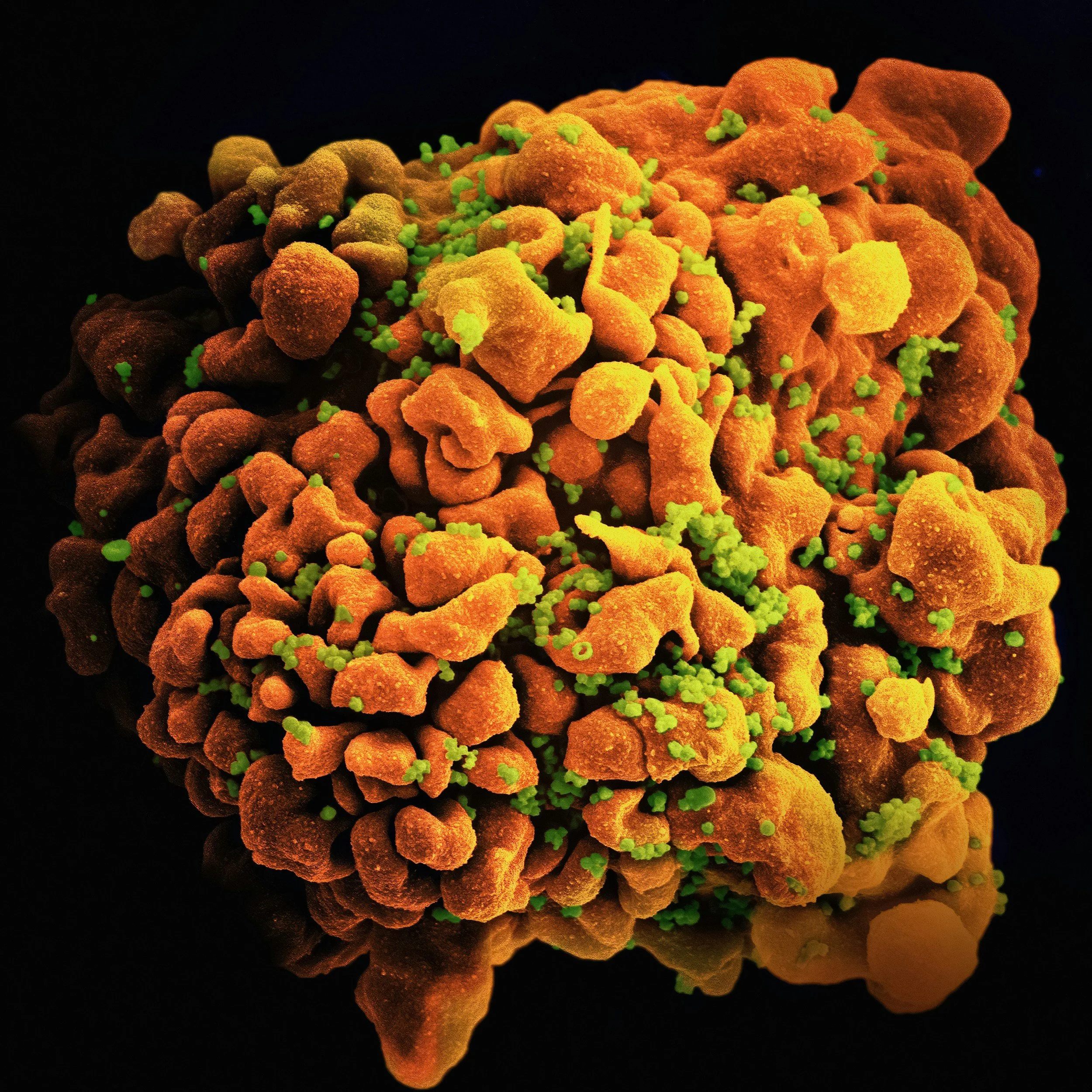 Colored scanning electron microscope image of a coronavirus particle with spike proteins.