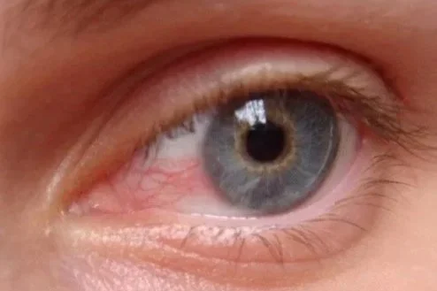 Dry, Irritated Eyes: What's Really Going On &amp; What You Can Do About It