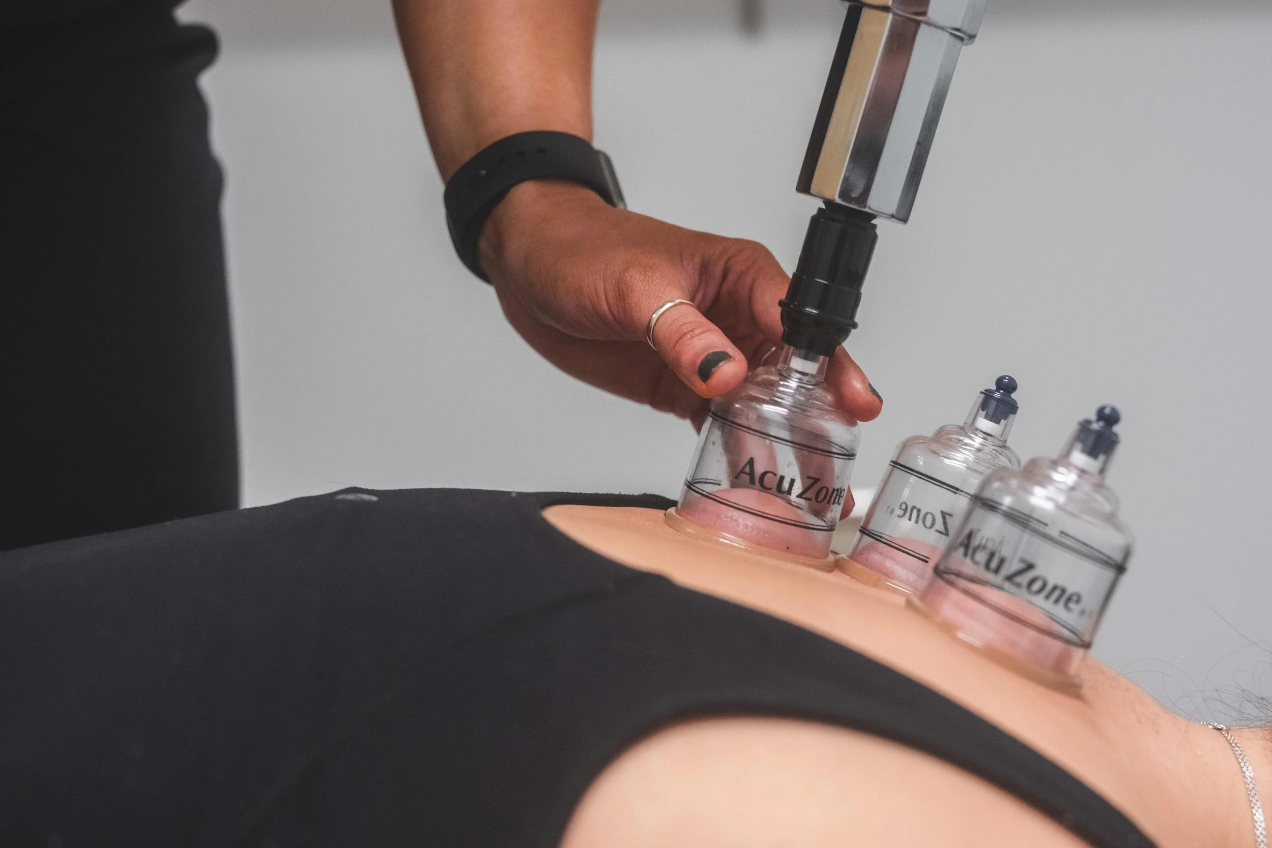 Cupping therapy, chiropractor, Acupuncture, Regina