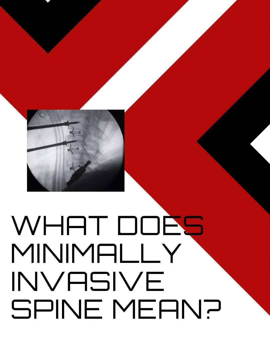 Minimally invasive spine surgery refers to procedures that allow surgeons to treat spinal conditions using smaller incisions and specialized instruments instead of larger traditional approaches.

The goal is precision, less disruption to surrounding 