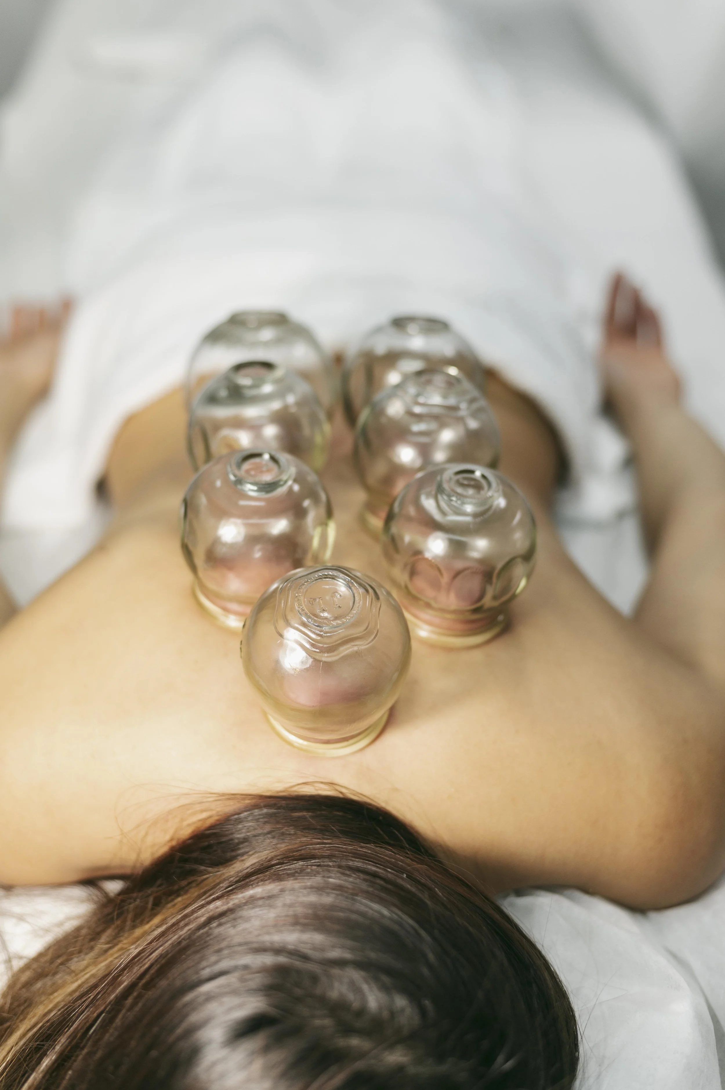 Person lying face down receiving cupping therapy with multiple glass cups on their back.