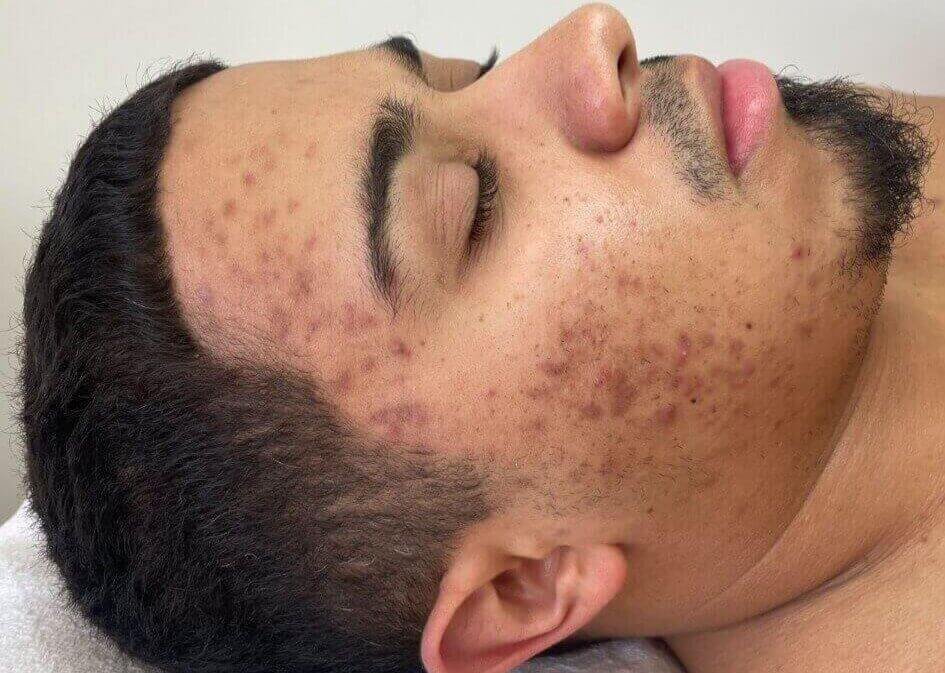 Close-up of a young man's face with acne and skin irritation, lying down with eyes closed.