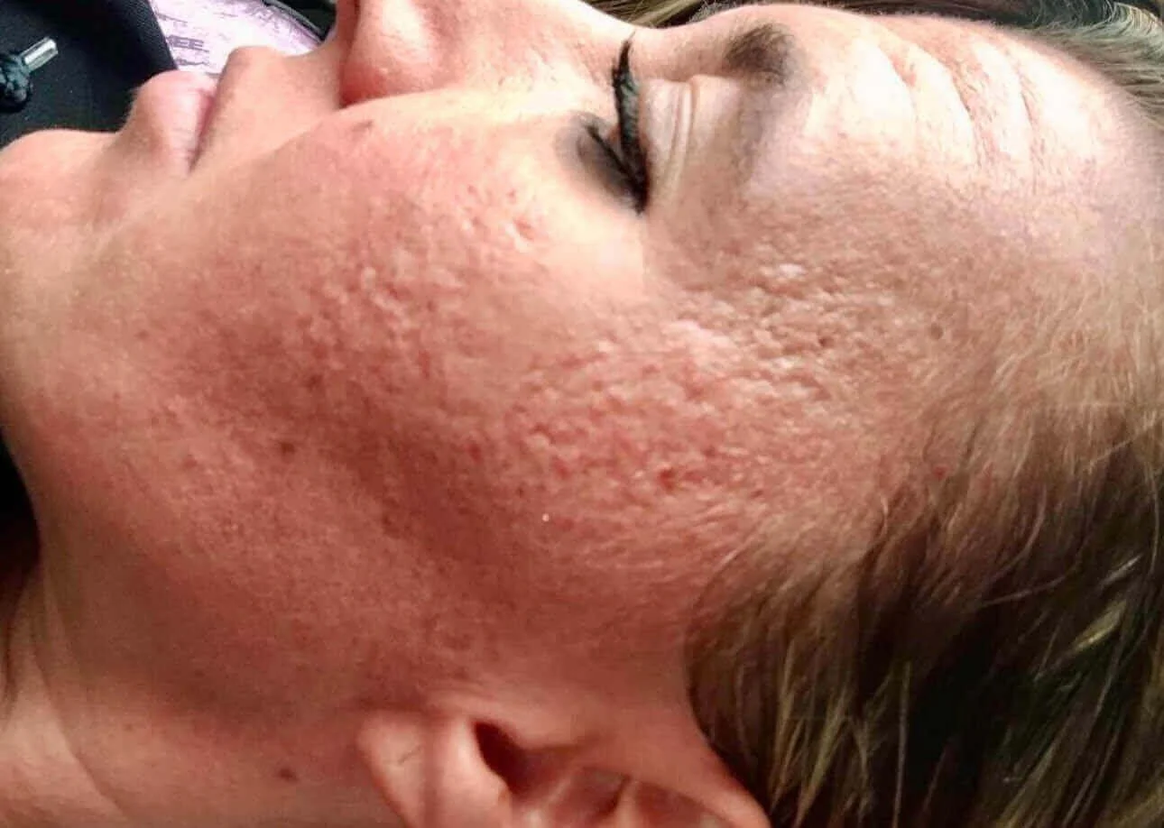 Close-up of a woman's face showing severe acne and redness