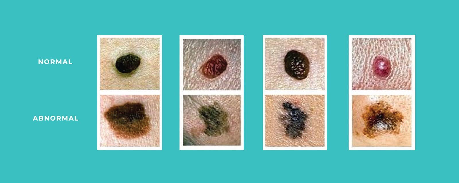 Skin Cancer — Ferrara Dermatology & The Skin and Laser Center of Grosse ...