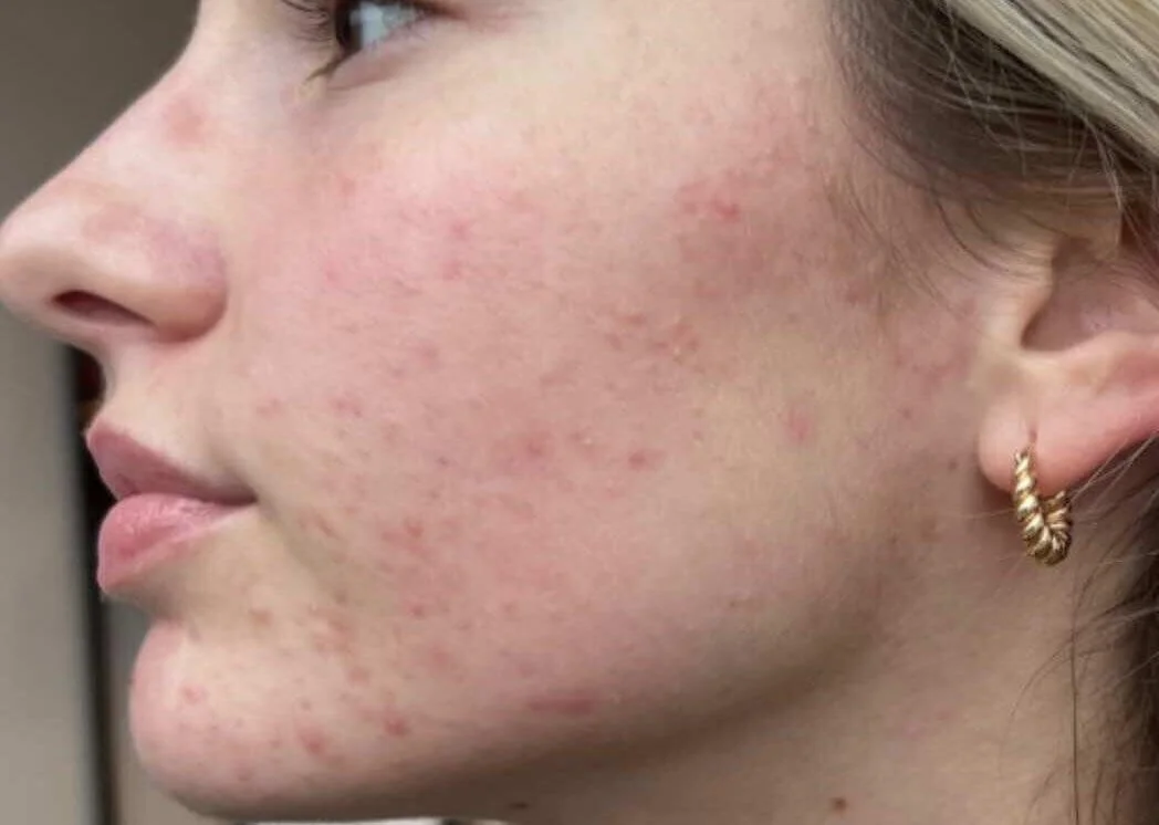Close-up of a woman's face showing acne and redness on her cheek.