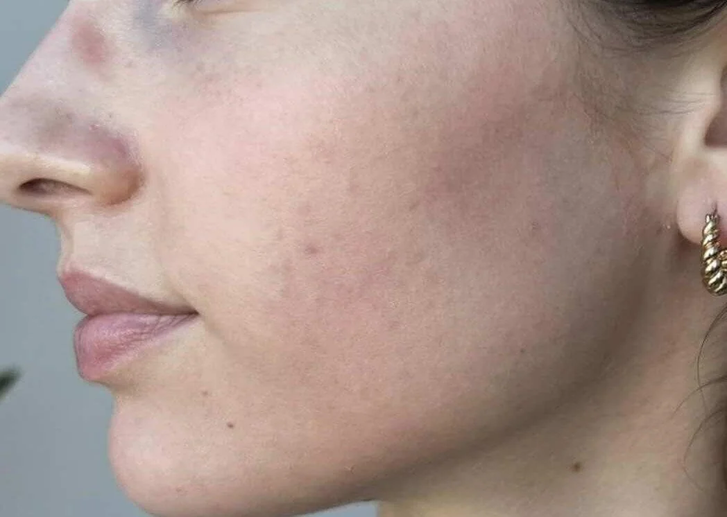 Close-up of a woman's face showing clear skin with slight redness and a few small blemishes.
