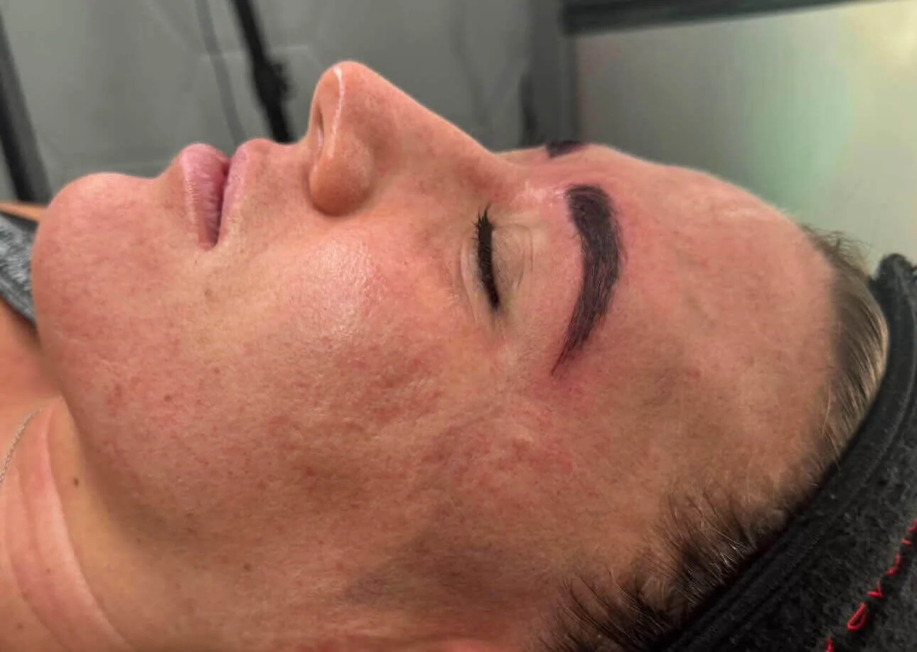 Close-up of a person's face with recently tattooed eyebrows, lying down with eyes closed, in a clinical setting.