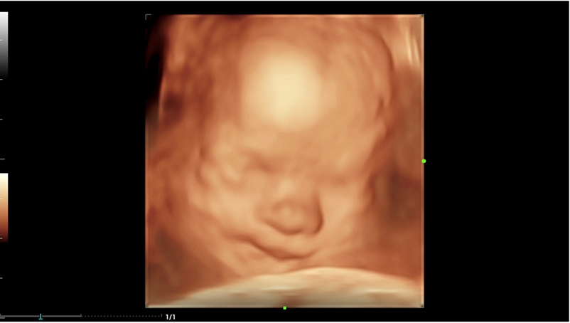 3D ultrasound image of a smiling baby.