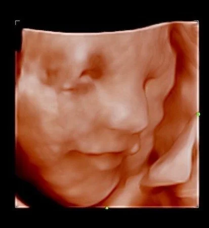 3D ultrasound image of a fetus with facial features visible, showing closed eyes and lips.