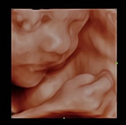Close-up of a 3D ultrasound image of a fetus.