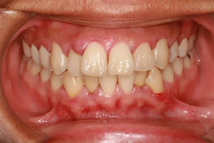 Swollen gums