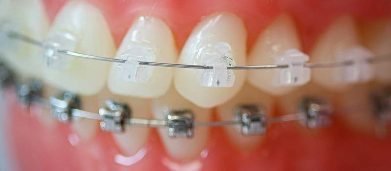 Traditional braces