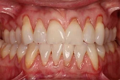 Gum recession