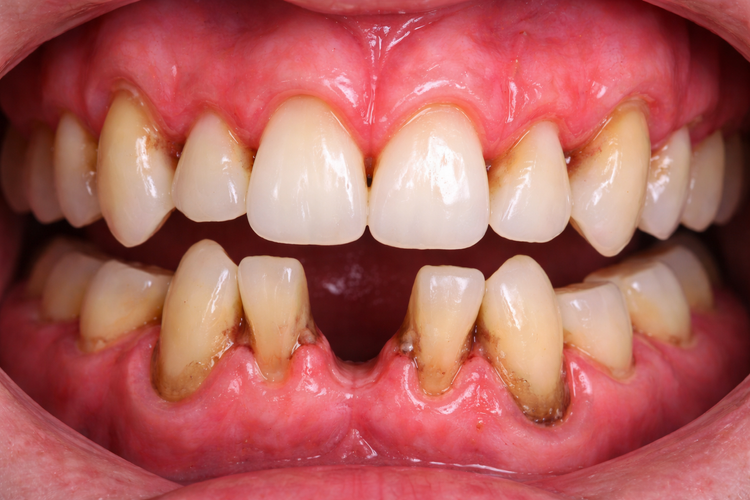 Advanced periodontitis