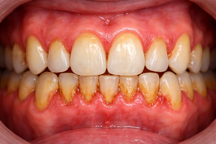 Early periodontitis