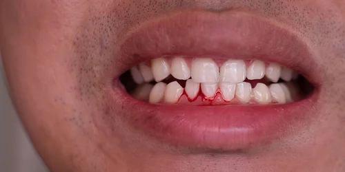 Gingivitis