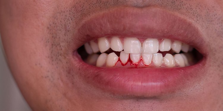 Bleeding gums