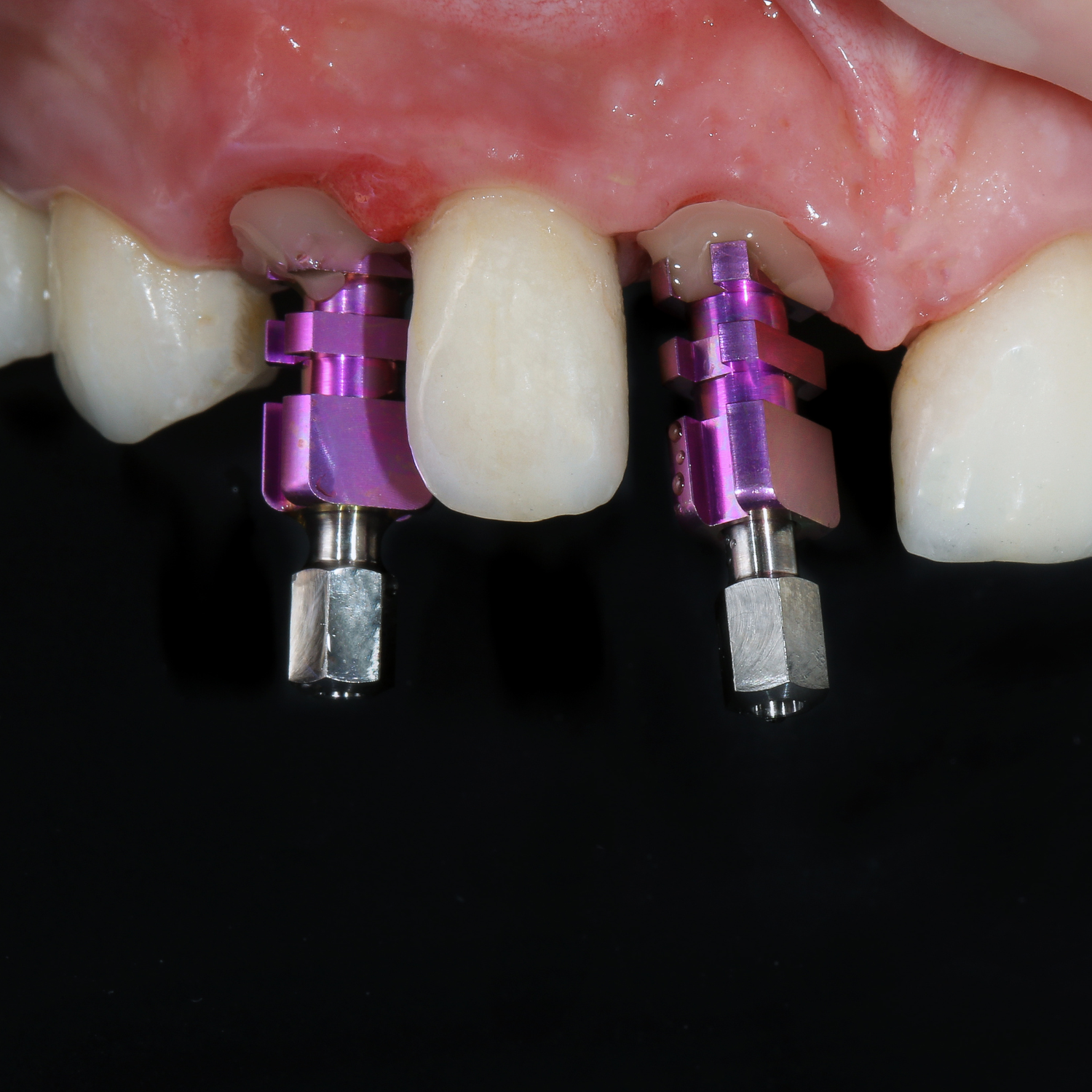 Dental implants with purple abutments and adjacent teeth in the upper jaw