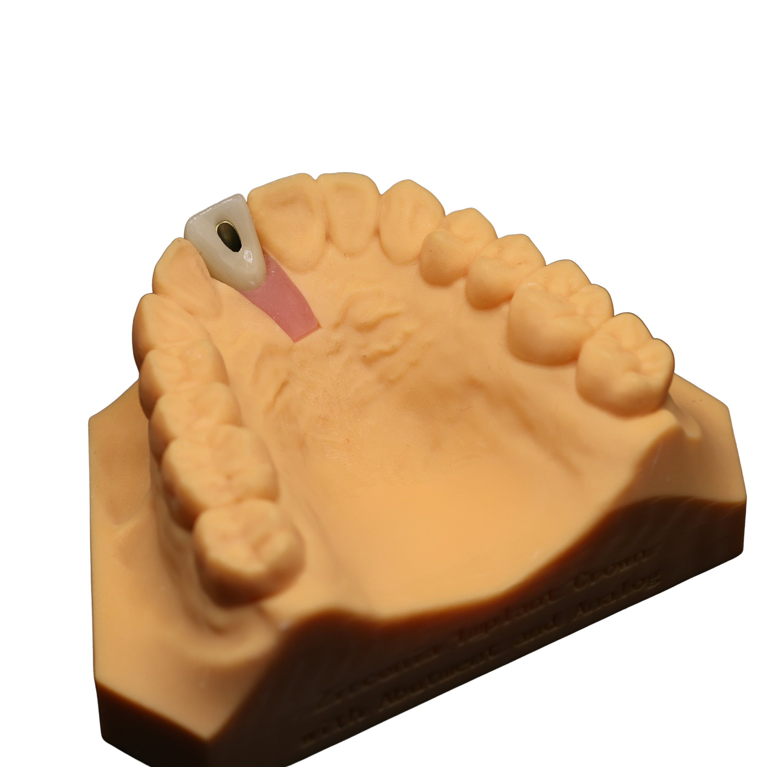 A dental mold of the upper jaw showing teeth, with a titanium implant abutment on the left side.