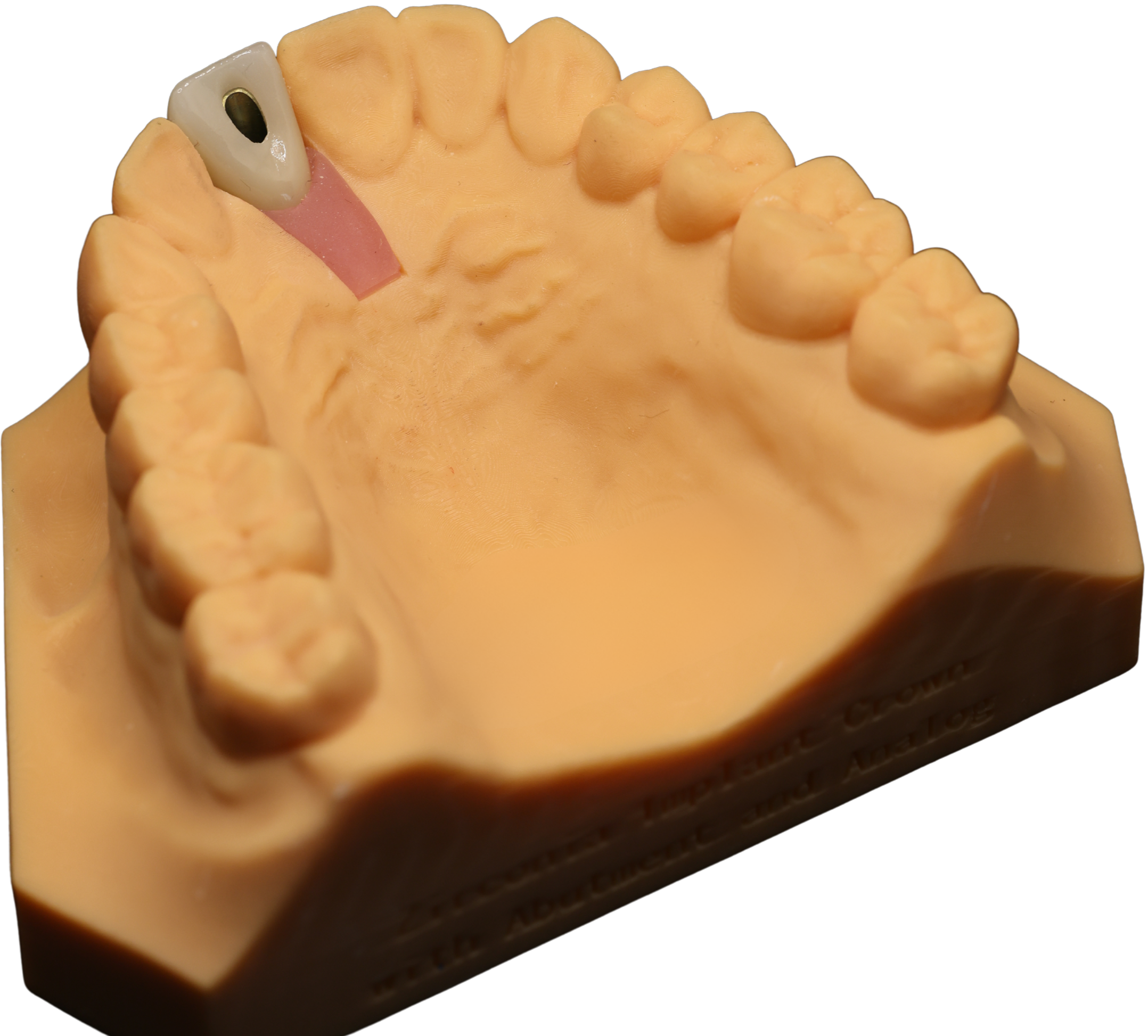 Dental mold showing upper teeth with dental implant at the back left.}