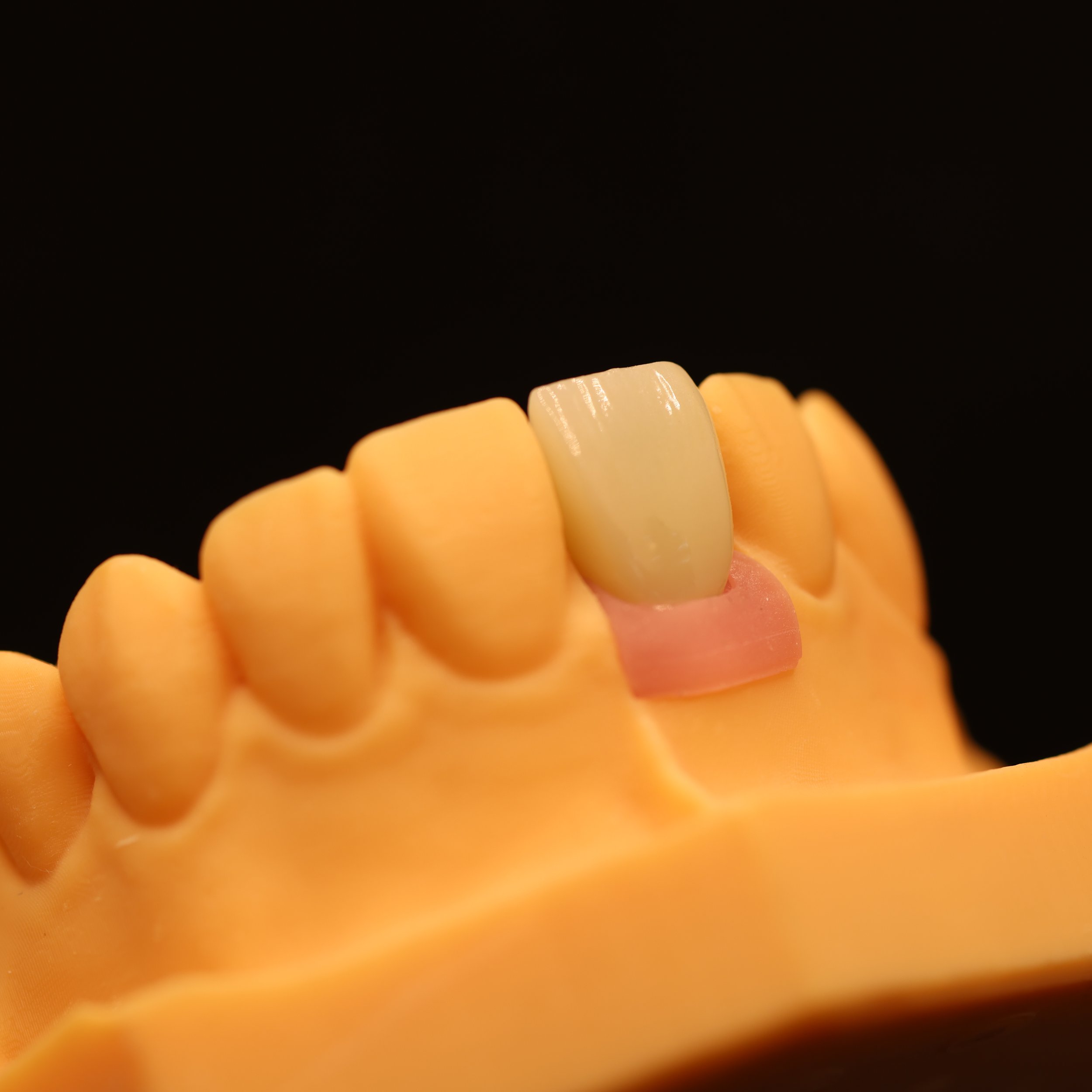 Close-up of a yellow denture with a central, slightly chipped tooth, against a black background.
