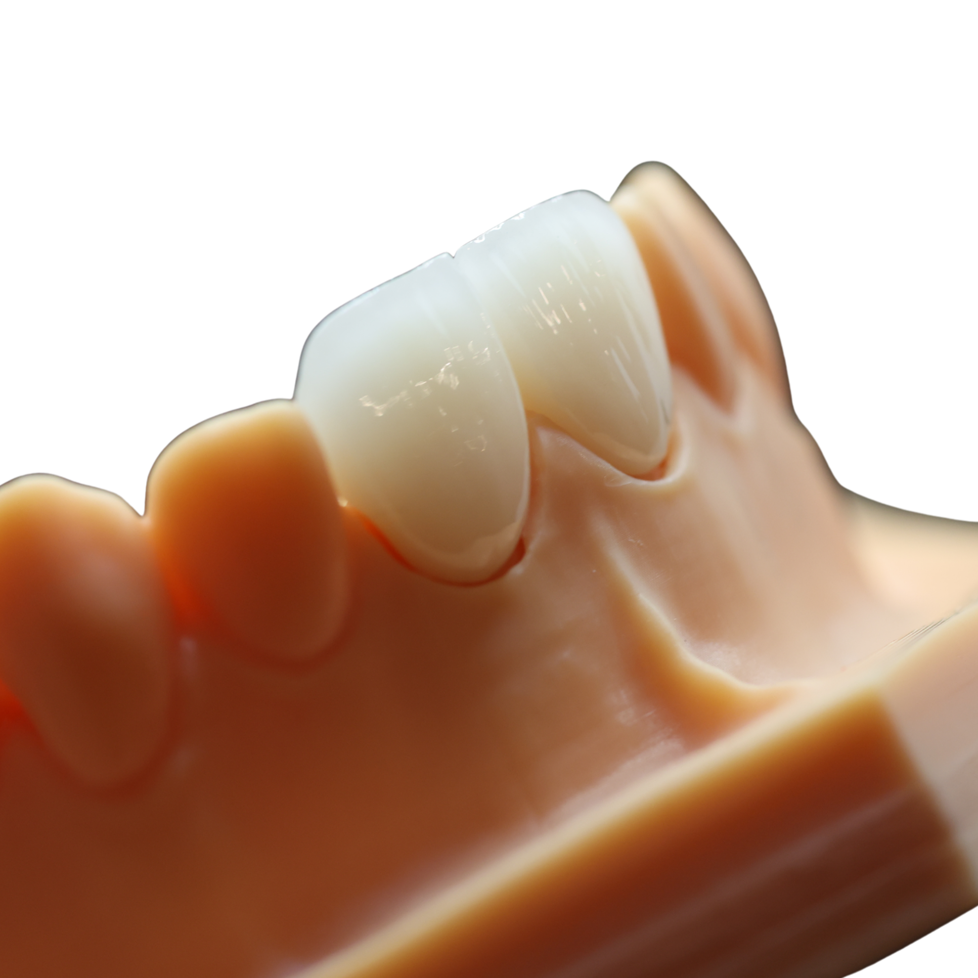 Close-up of a dental model showing a row of teeth, with a focus on the front teeth.