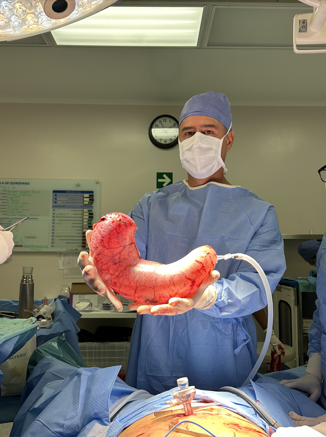 Un cirujano en un quirófano sosteniendo un estómago humano en una mano, durante una cirugía.