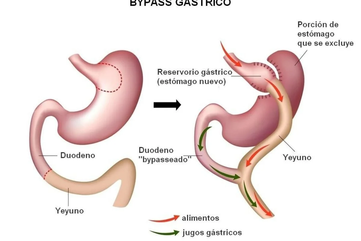 Bypass Gástrico