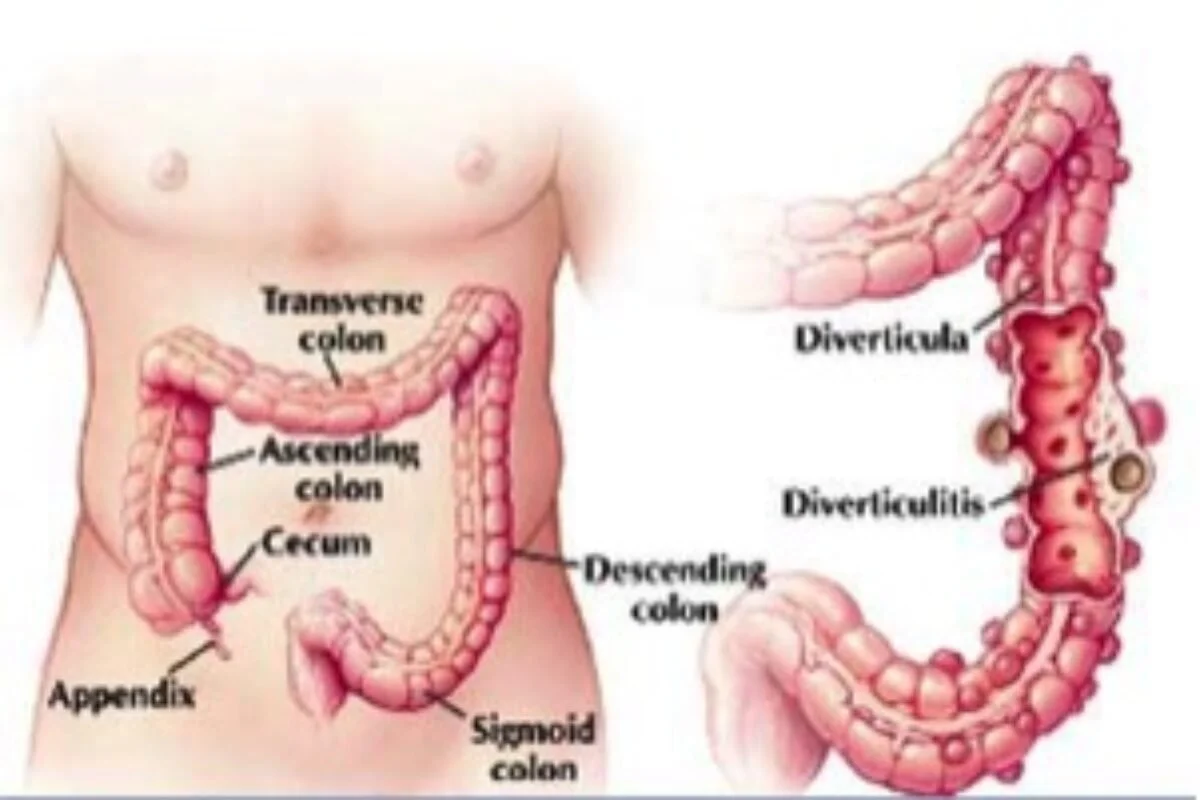 Diverticulos de colon