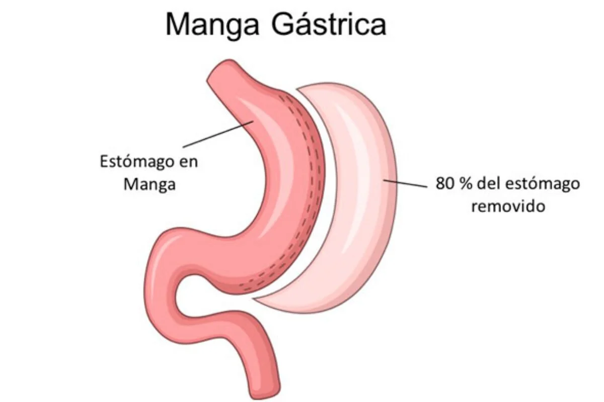Manga gástrica laparoscópica - dudas más frecuencias 