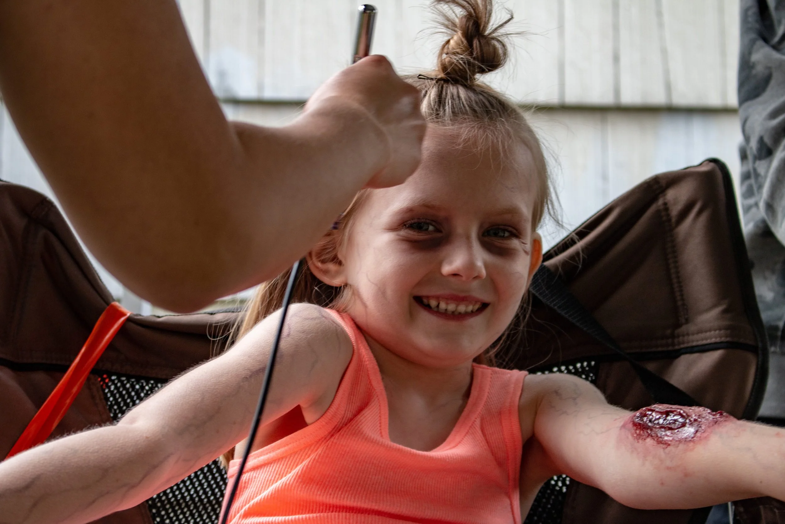 A young girl with a smile, sitting in a wheelchair with a large open wound on her arm, while someone appears to be dressing or examining it.