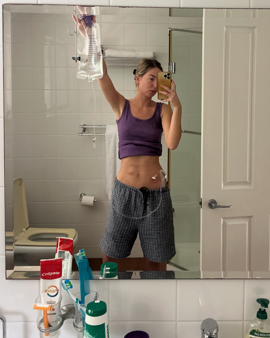 Mirror selfie of a woman wearing a purple tank top and patterned shorts in a bathroom, holding up a clear fluid IV bag connected by tubing to a medical tube on her abdomen.