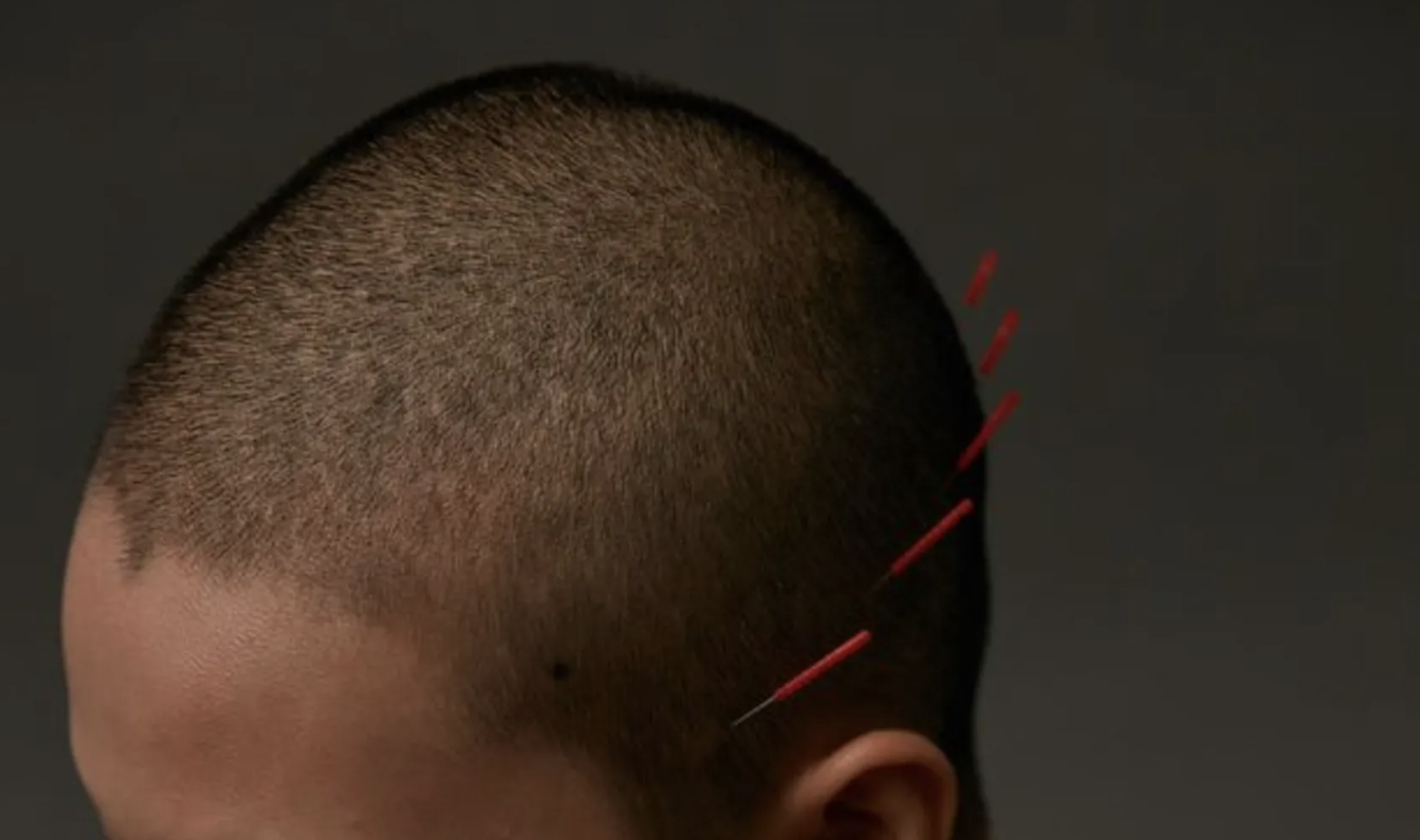 A person with a close-shaved haircut, with red markings indicating points along the scalp for acupuncture or medical treatment.