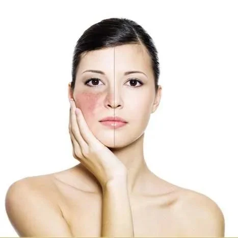 Thermavein Red Vein Removal in Cornwall