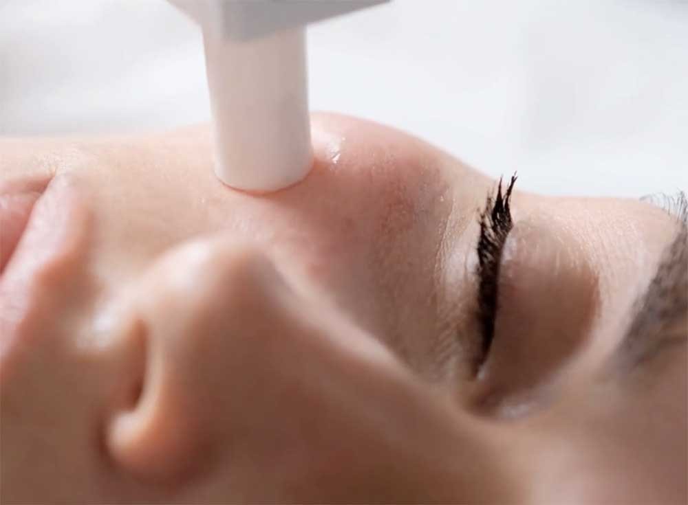Microdermabrasion facials in Cornwall