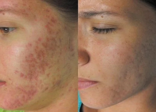 Before and After Microneedling using the skin pen - reduces blemishes