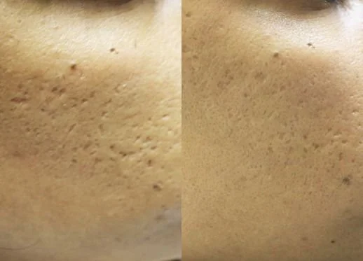 Microneedling smoothes skins surface