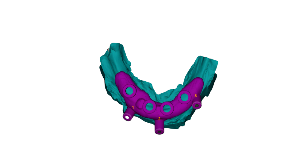 3D medical model of lower jaw with dental implants in purple, numbered 1 to 3, set in a blue-green jawbone.