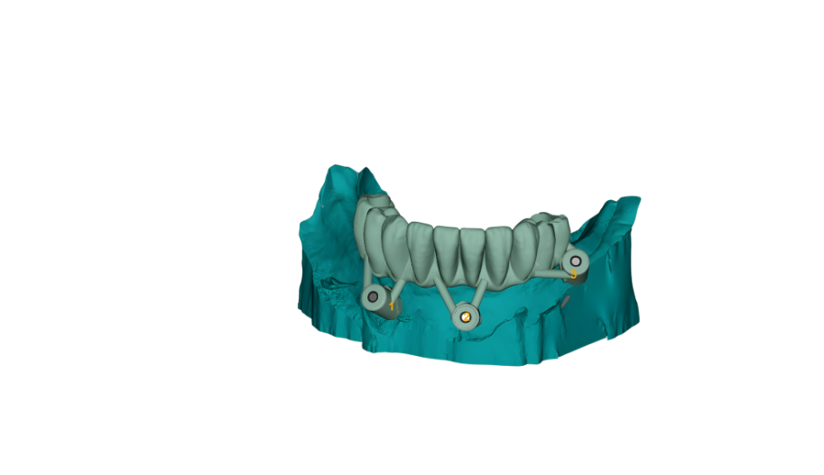 3D digital rendering of a dental implant model showing the lower jaw with teeth, implant screws, and surgical guide.