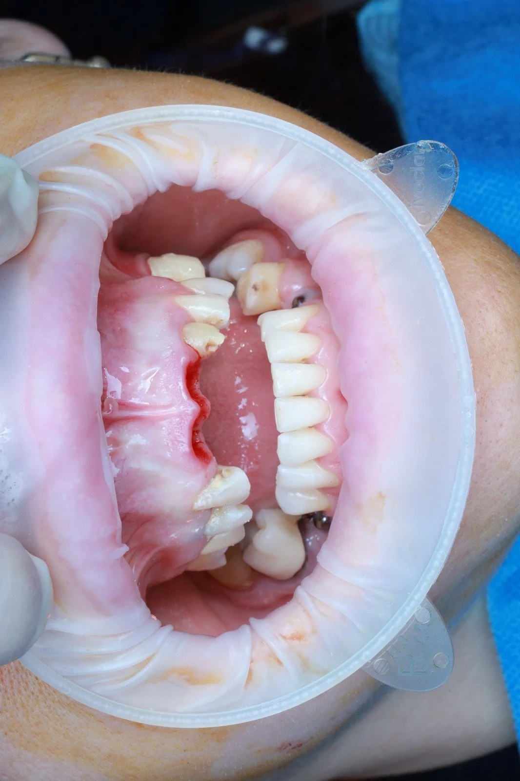 Close-up of a dental model showing teeth with signs of decay and staining, held open by a dentist's gloved hand.