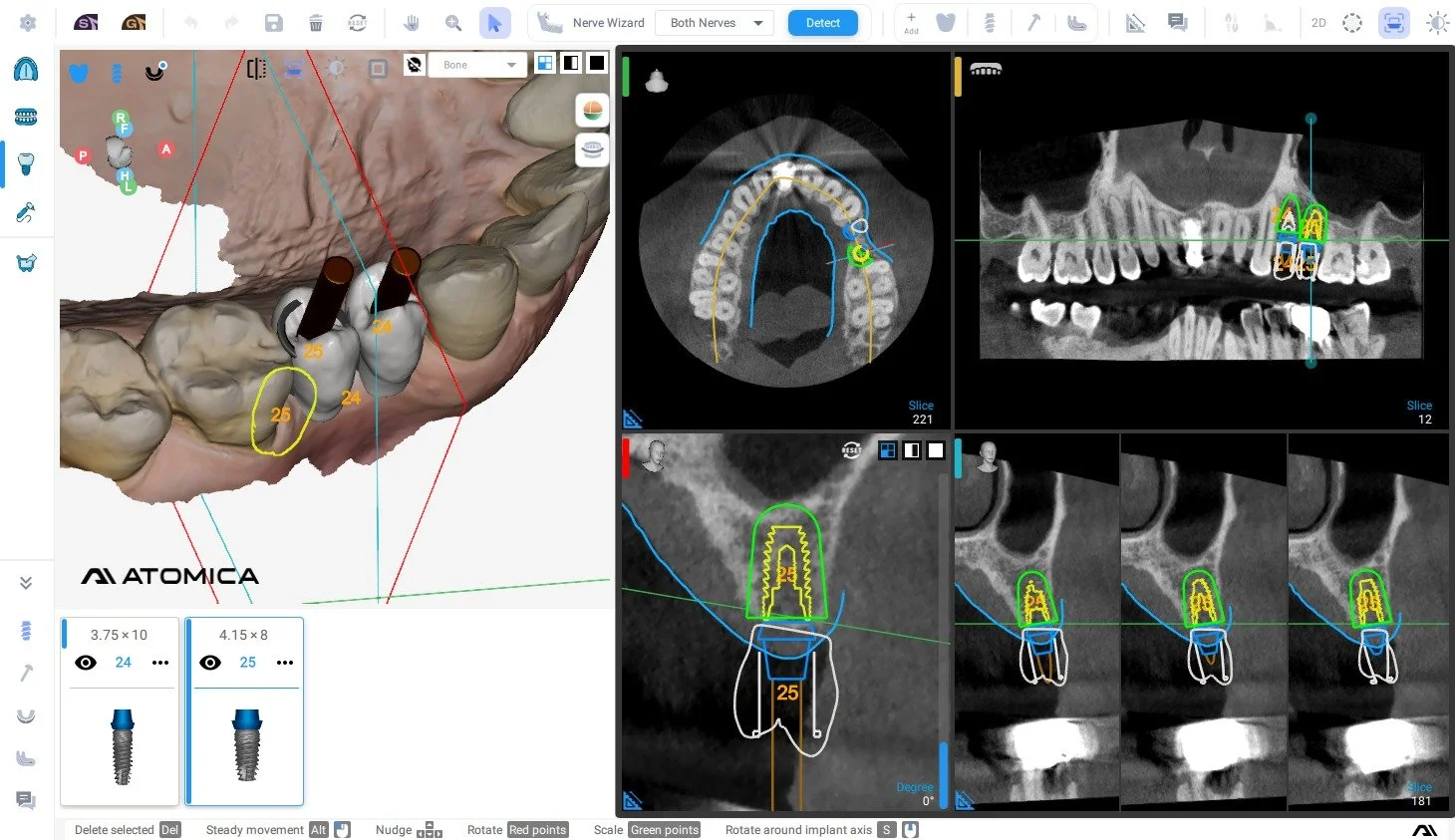 A dental imaging software screen displaying a 3D digital model of the upper jaw with dental implants, along with panoramic, cross-sectional, and 3D views of the dental structure and implants.