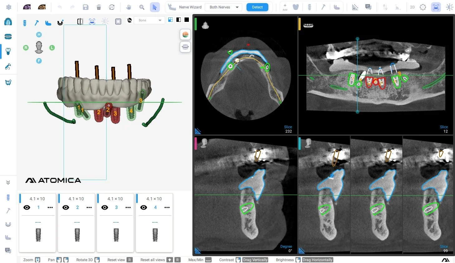 Dentist's digital scan of dental implants and their placement in the upper jaw with detailed 3D and cross-sectional views.