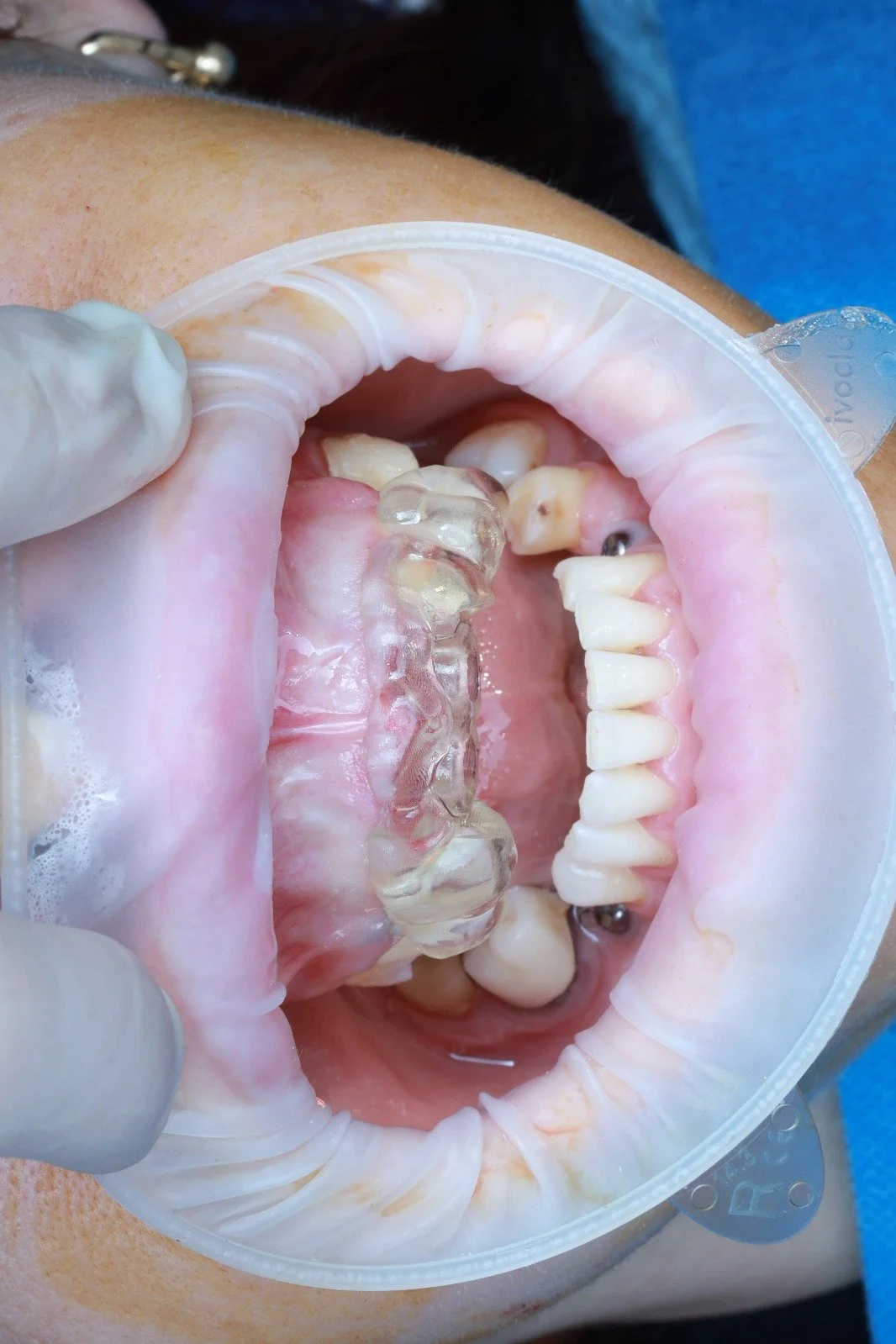 A dental professional holding a clear dental night guard over a patient's open mouth, revealing teeth and gums.