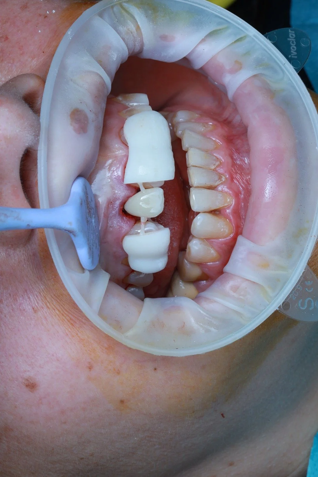 Close-up of a dental model with dental crowns and a dental cleaning tool placed inside the mouth