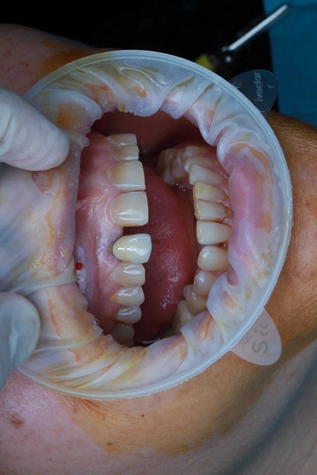 Close-up of a dental mold in a person's mouth, held with a gloved hand, showing upper and lower teeth.